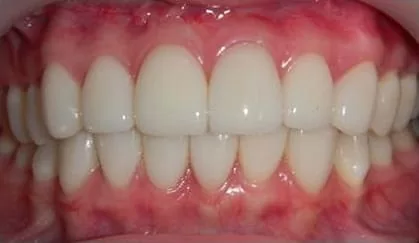 全瓷牙齒美容讓我 擁有潔白的牙齒、迷人的笑容