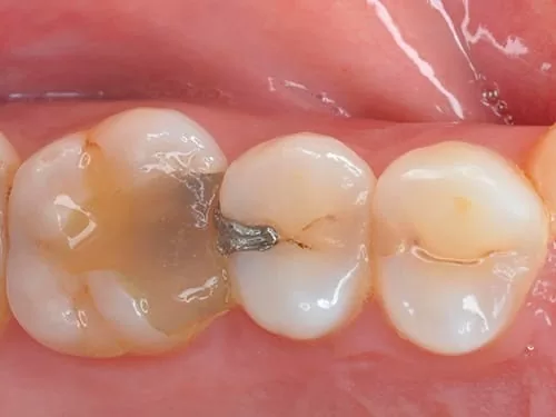 你看得出來我有蛀牙嗎？