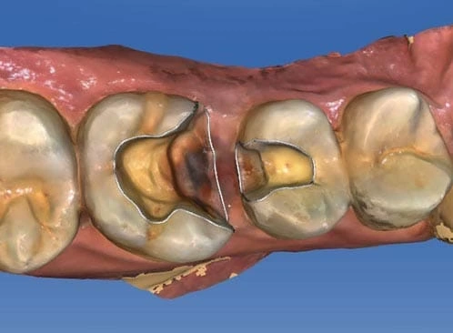你看得出來我有蛀牙嗎？