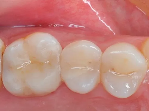 你看得出來我有蛀牙嗎？