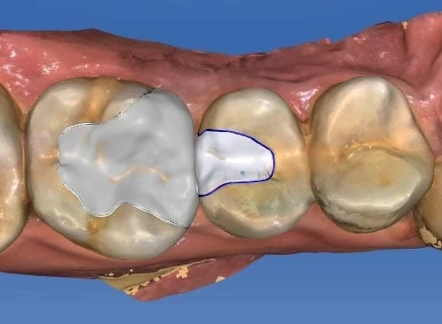 你看得出來我有蛀牙嗎？