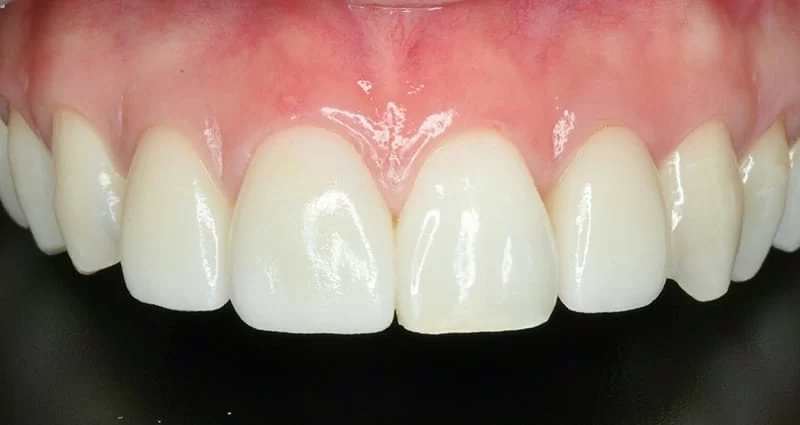 您分辨得出來哪幾顆是假牙嗎？