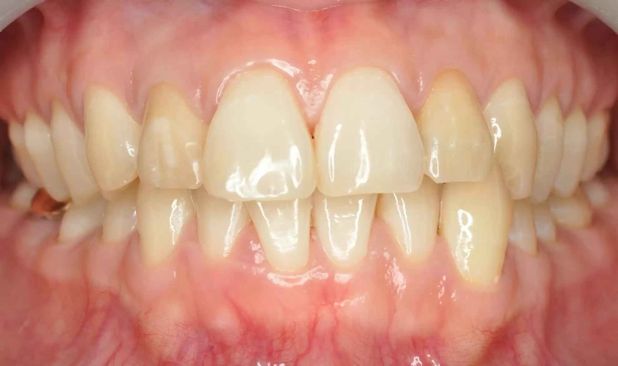 proimages/case/case-intro/digital-deramic-restoration/digital-deramic-restoration23/0101.jpg proimages/case/case-intro/digital-deramic-restoration/digital-deramic-restoration23/0101.jpg