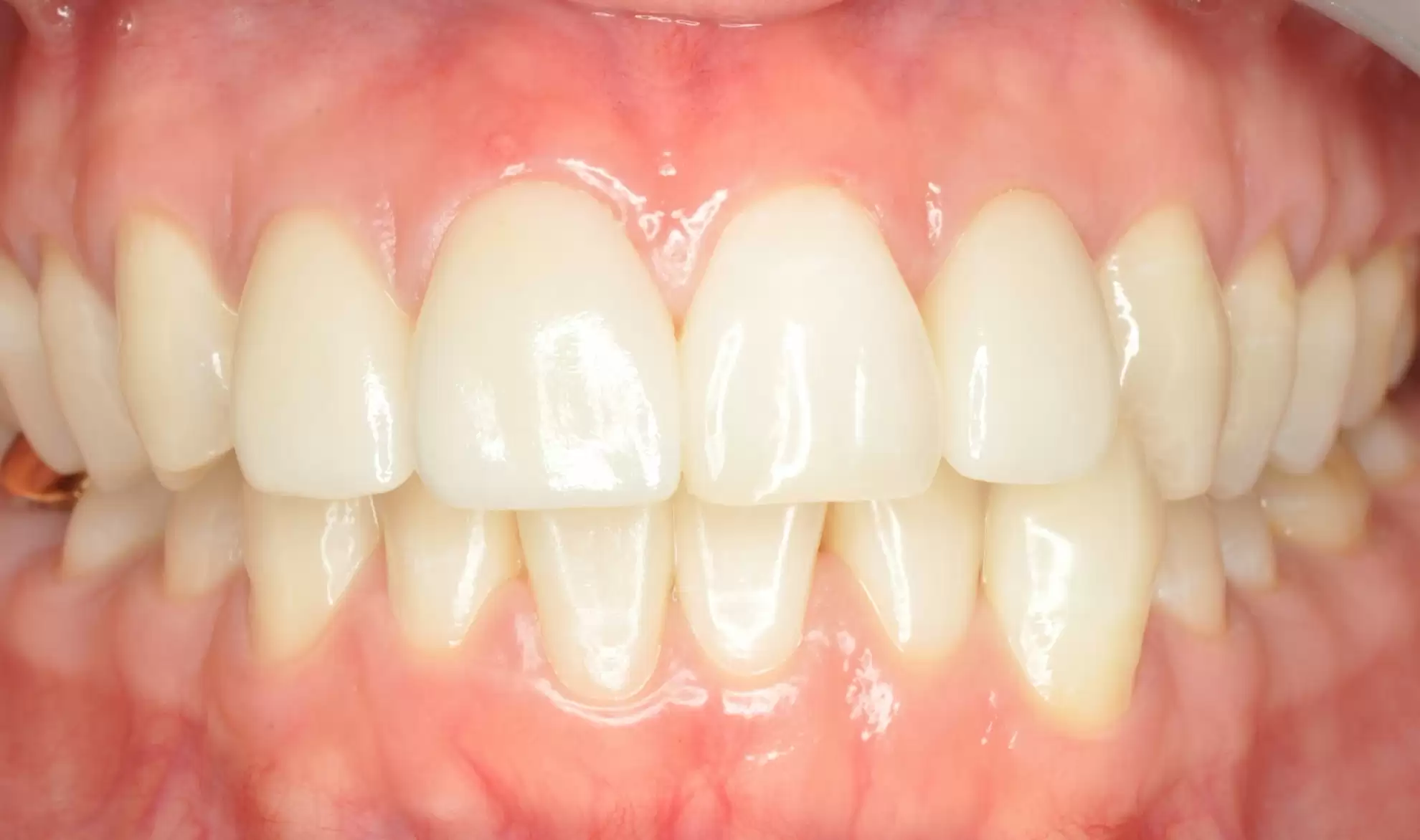 proimages/case/case-intro/digital-deramic-restoration/digital-deramic-restoration23/0102.jpg proimages/case/case-intro/digital-deramic-restoration/digital-deramic-restoration23/0102.jpg