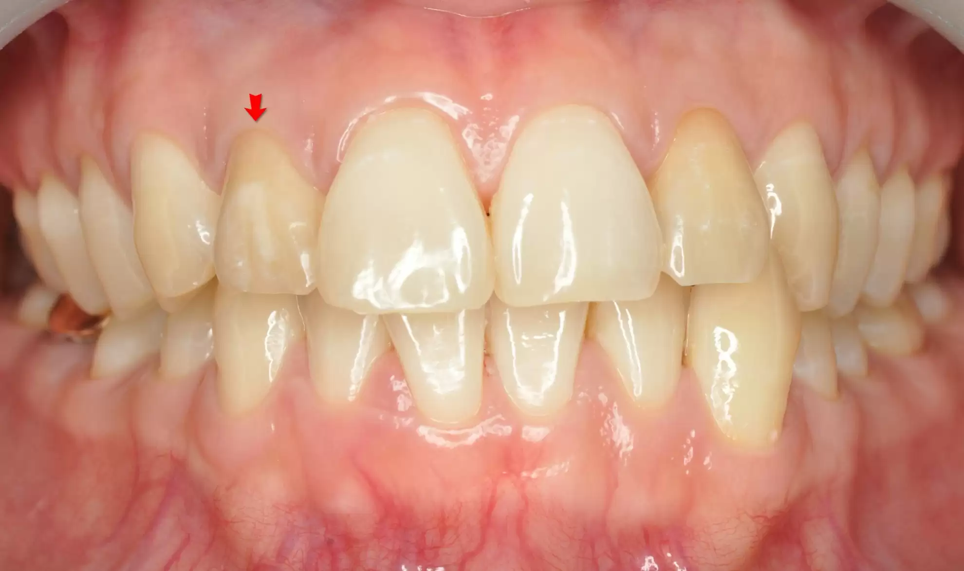 proimages/case/case-intro/digital-deramic-restoration/digital-deramic-restoration23/0103.jpg proimages/case/case-intro/digital-deramic-restoration/digital-deramic-restoration23/0103.jpg