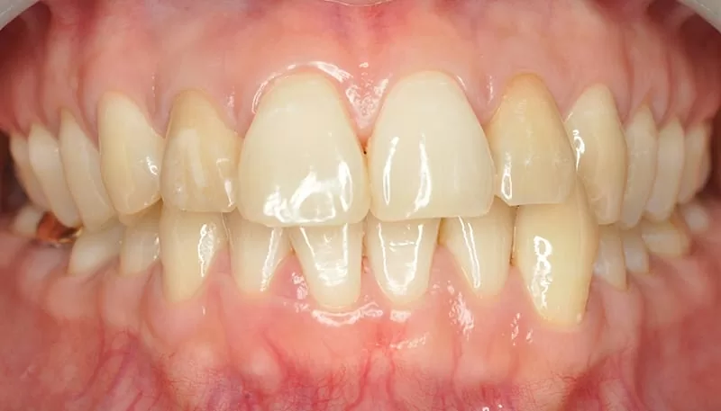 您分辨得出來哪幾顆是假牙嗎？