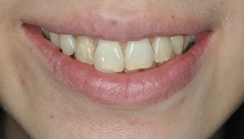 您分辨得出來哪幾顆是假牙嗎？