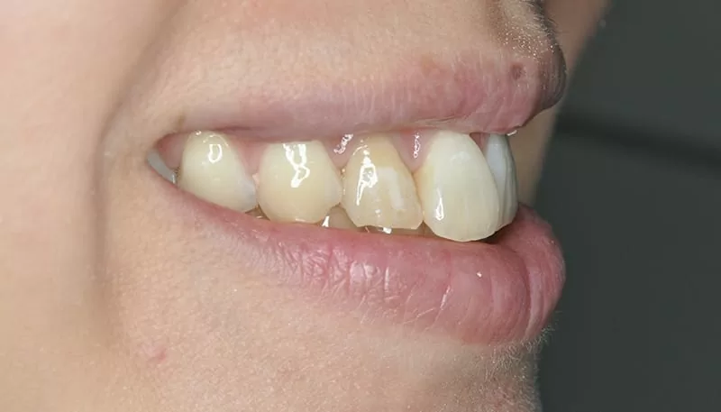 您分辨得出來哪幾顆是假牙嗎？