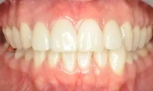 您分辨得出來哪幾顆是假牙嗎？