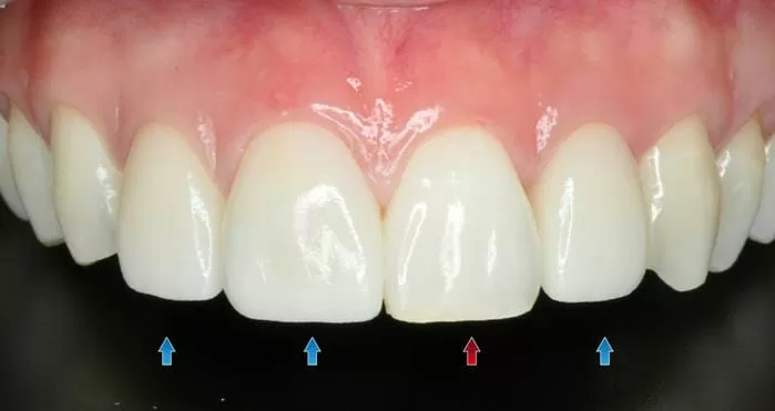 您分辨得出來哪幾顆是假牙嗎？