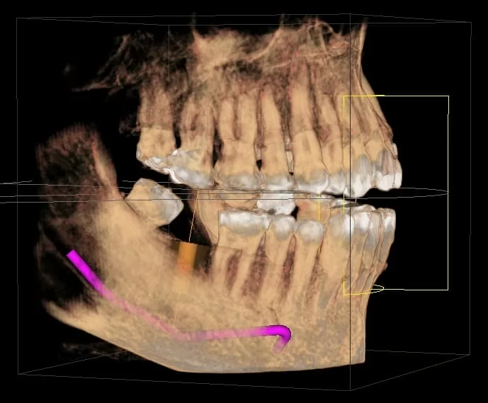 proimages/case/case-intro/digital-deramic-restoration/digital-deramic-restoration24/0.jpg proimages/case/case-intro/digital-deramic-restoration/digital-deramic-restoration24/0.jpg