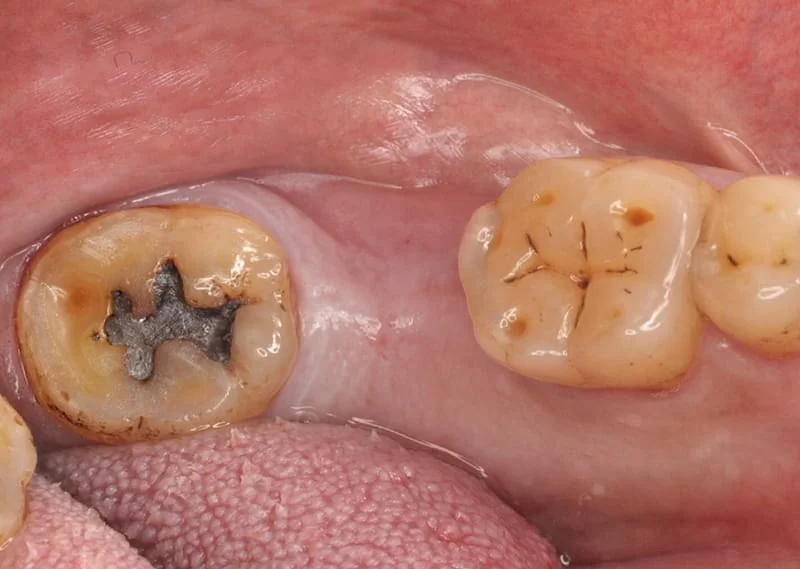 proimages/case/case-intro/digital-deramic-restoration/digital-deramic-restoration24/1.jpg proimages/case/case-intro/digital-deramic-restoration/digital-deramic-restoration24/1.jpg