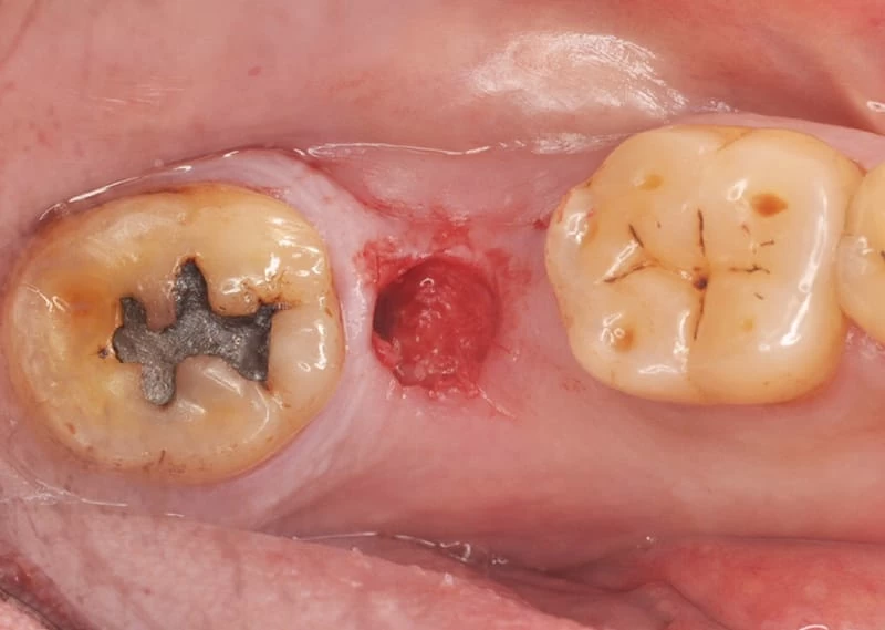 proimages/case/case-intro/digital-deramic-restoration/digital-deramic-restoration24/2.jpg proimages/case/case-intro/digital-deramic-restoration/digital-deramic-restoration24/2.jpg