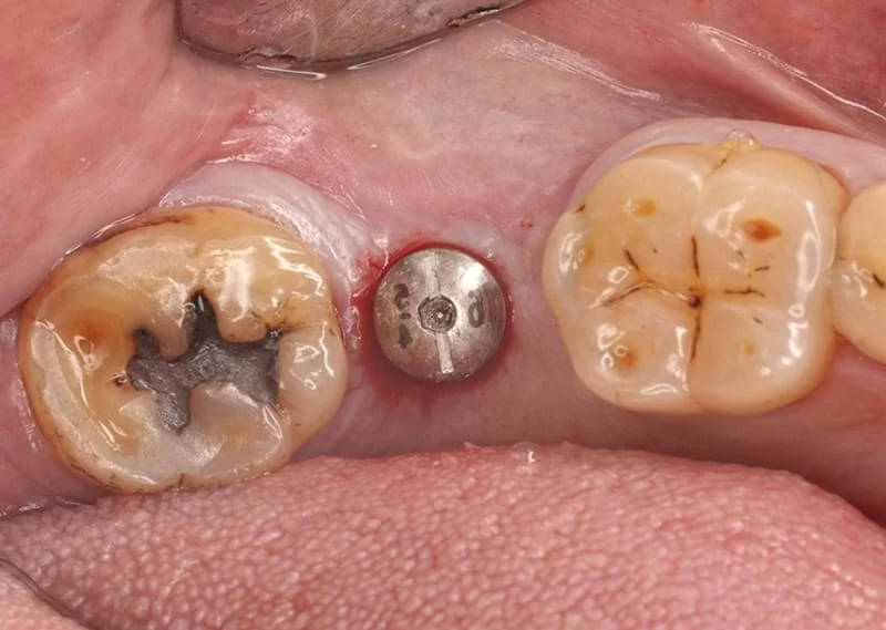 proimages/case/case-intro/digital-deramic-restoration/digital-deramic-restoration24/3.jpg proimages/case/case-intro/digital-deramic-restoration/digital-deramic-restoration24/3.jpg