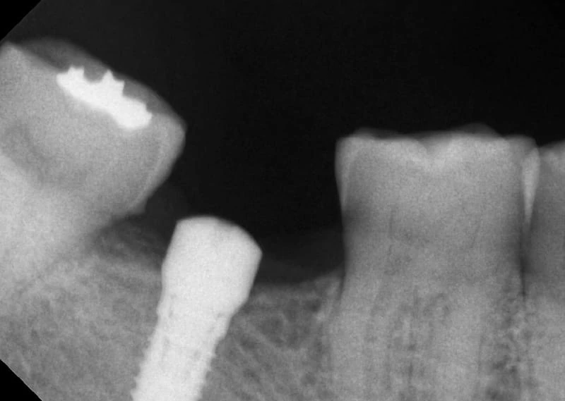 proimages/case/case-intro/digital-deramic-restoration/digital-deramic-restoration24/4.jpg proimages/case/case-intro/digital-deramic-restoration/digital-deramic-restoration24/4.jpg