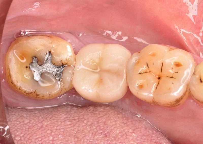 proimages/case/case-intro/digital-deramic-restoration/digital-deramic-restoration24/5.jpg proimages/case/case-intro/digital-deramic-restoration/digital-deramic-restoration24/5.jpg