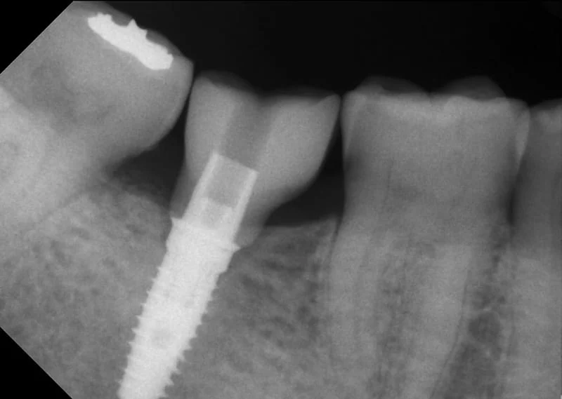 proimages/case/case-intro/digital-deramic-restoration/digital-deramic-restoration24/6.jpg proimages/case/case-intro/digital-deramic-restoration/digital-deramic-restoration24/6.jpg