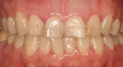 整合性牙齒美容,擁有微笑曲線展現潔白健康齒色 整合性牙齒美容,擁有微笑曲線展現潔白健康齒色