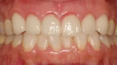 整合性牙齒美容,擁有微笑曲線展現潔白健康齒色 整合性牙齒美容,擁有微笑曲線展現潔白健康齒色