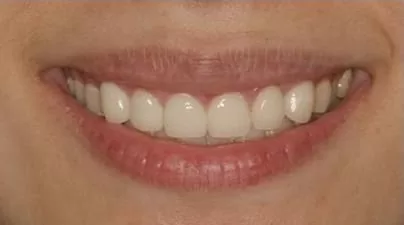 整合性牙齒美容,擁有微笑曲線展現潔白健康齒色 整合性牙齒美容,擁有微笑曲線展現潔白健康齒色