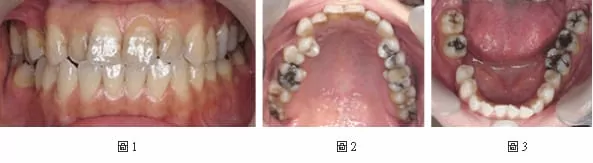 全口合併矯正、牙周、植牙、假牙治療 全口合併矯正、牙周、植牙、假牙治療