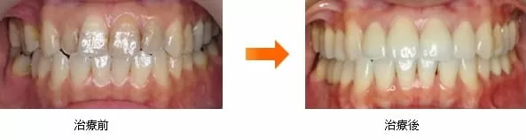 全口合併矯正、牙周、植牙、假牙治療 全口合併矯正、牙周、植牙、假牙治療