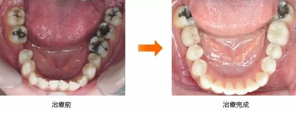 全口合併矯正、牙周、植牙、假牙治療 全口合併矯正、牙周、植牙、假牙治療