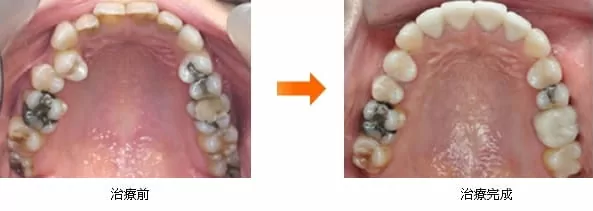 全口合併矯正、牙周、植牙、假牙治療 全口合併矯正、牙周、植牙、假牙治療