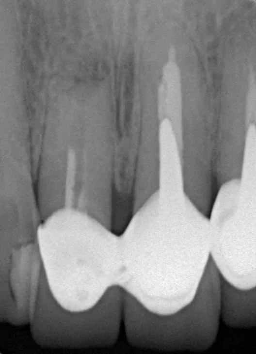 門牙植牙合併3D齒雕牙套,恢復牙齒功能與自信 門牙植牙合併3D齒雕牙套,恢復牙齒功能與自信