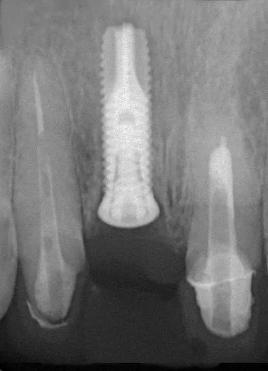 門牙植牙合併3D齒雕牙套,恢復牙齒功能與自信 門牙植牙合併3D齒雕牙套,恢復牙齒功能與自信