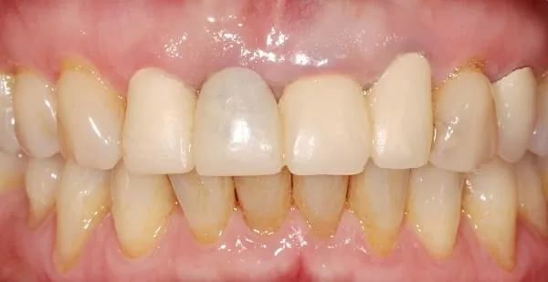 門牙植牙合併3D齒雕牙套,恢復牙齒功能與自信 門牙植牙合併3D齒雕牙套,恢復牙齒功能與自信