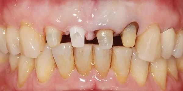 門牙植牙合併3D齒雕牙套,恢復牙齒功能與自信 門牙植牙合併3D齒雕牙套,恢復牙齒功能與自信