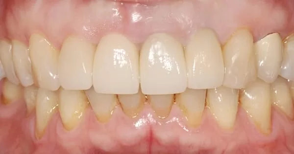 門牙植牙合併3D齒雕牙套,恢復牙齒功能與自信 門牙植牙合併3D齒雕牙套,恢復牙齒功能與自信