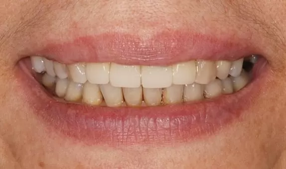 門牙植牙合併3D齒雕牙套,恢復牙齒功能與自信 門牙植牙合併3D齒雕牙套,恢復牙齒功能與自信