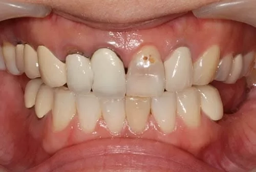 全口植牙假牙重建咬合功能,恢復光采笑容 全口植牙假牙重建咬合功能,恢復光采笑容