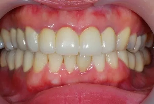 全口植牙假牙重建咬合功能,恢復光采笑容 全口植牙假牙重建咬合功能,恢復光采笑容