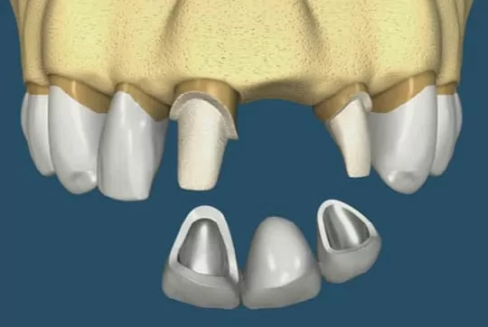 騎車意外摔斷牙，植牙讓我重拾笑容