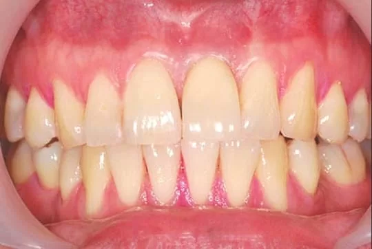 騎車意外摔斷牙，植牙讓我重拾笑容