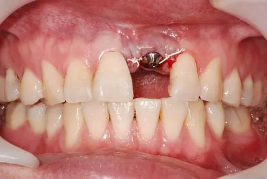 騎車意外摔斷牙，植牙讓我重拾笑容