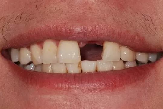 騎車意外摔斷牙，植牙讓我重拾笑容