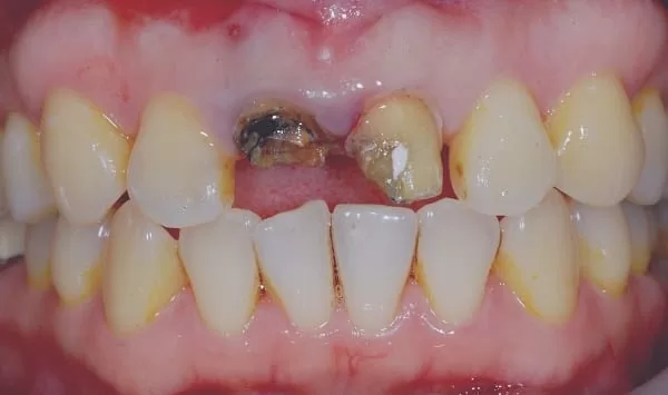 門牙植牙,有如自然牙般的真實 門牙植牙,有如自然牙般的真實