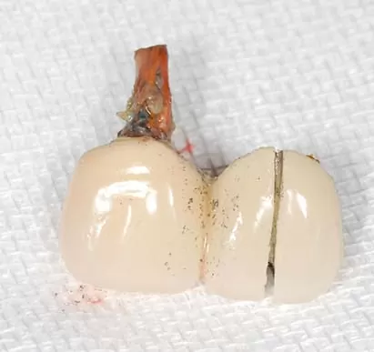 門牙植牙,有如自然牙般的真實 門牙植牙,有如自然牙般的真實