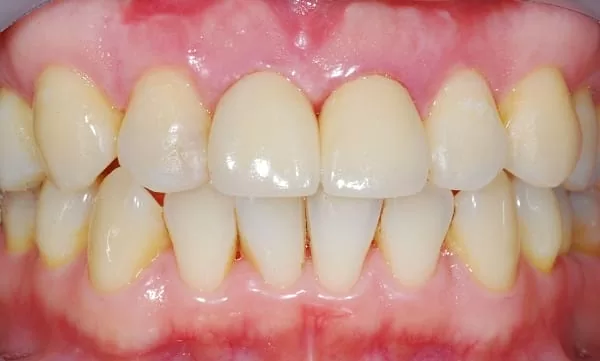 門牙植牙,有如自然牙般的真實 門牙植牙,有如自然牙般的真實