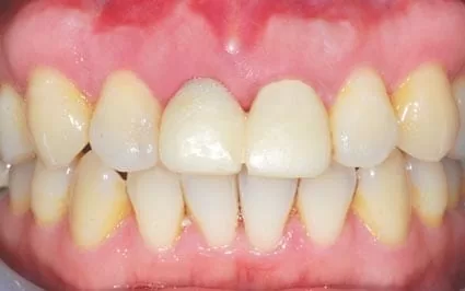 門牙植牙,有如自然牙般的真實 門牙植牙,有如自然牙般的真實