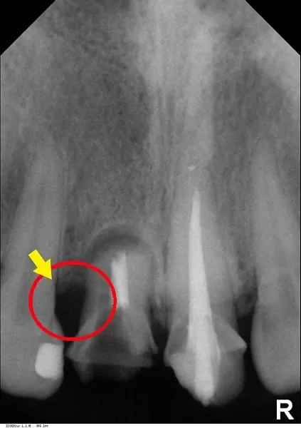 門牙植牙,有如自然牙般的真實 門牙植牙,有如自然牙般的真實