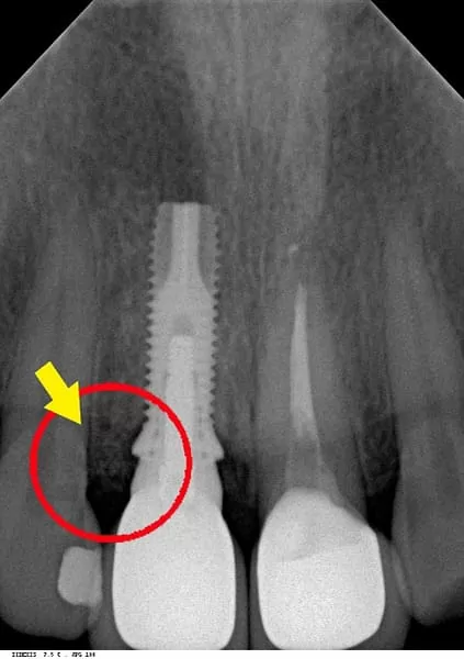 門牙植牙,有如自然牙般的真實 門牙植牙,有如自然牙般的真實