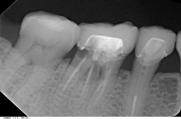 植牙成功關鍵，要美觀更要兼顧穩定性！！