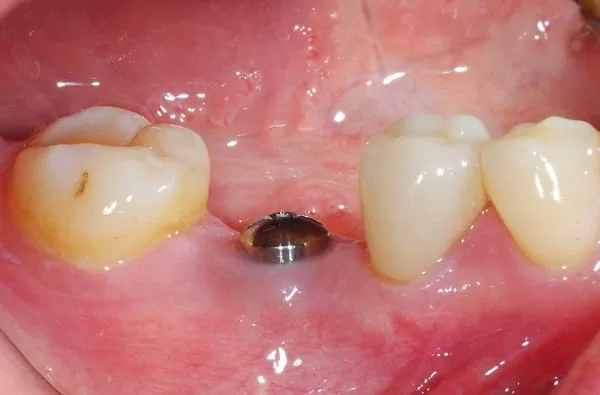 植牙成功關鍵，要美觀更要兼顧穩定性！！