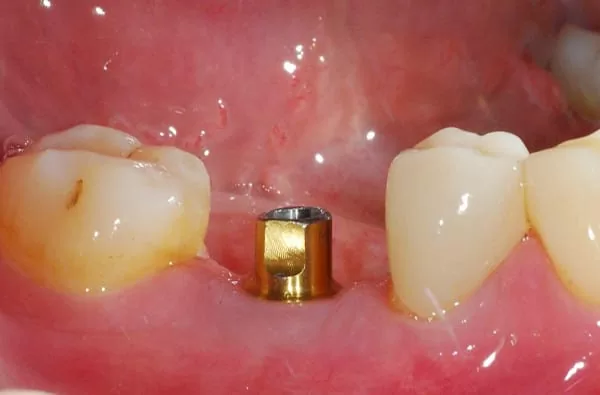 植牙成功關鍵，要美觀更要兼顧穩定性！！