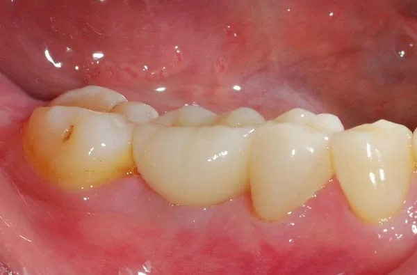 植牙成功關鍵，要美觀更要兼顧穩定性！！